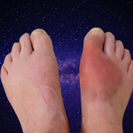 Waspada Asam Urat Bisa Mengancam Anak Muda!