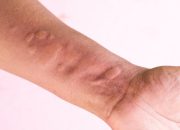 Tips Bagi yang Miliki Alergi Terhadap Cuaca Dingin