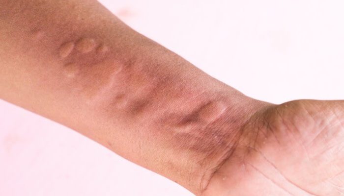 Tips Bagi yang Miliki Alergi Terhadap Cuaca Dingin