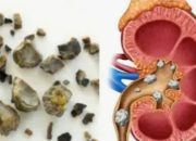 Penderita Batu Ginjal Harus Hindari Makanan ini!