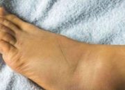 Keseimbangan Fungsi Ginjal dan Usus Pengaruhi Asam Urat