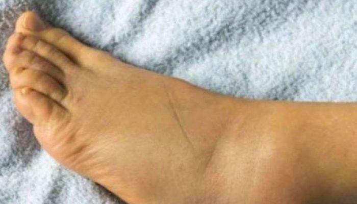 Keseimbangan Fungsi Ginjal dan Usus Pengaruhi Asam Urat